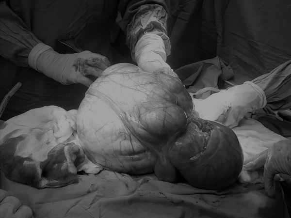 ホーチミン：女性から6.3キロの子宮腫瘍摘出