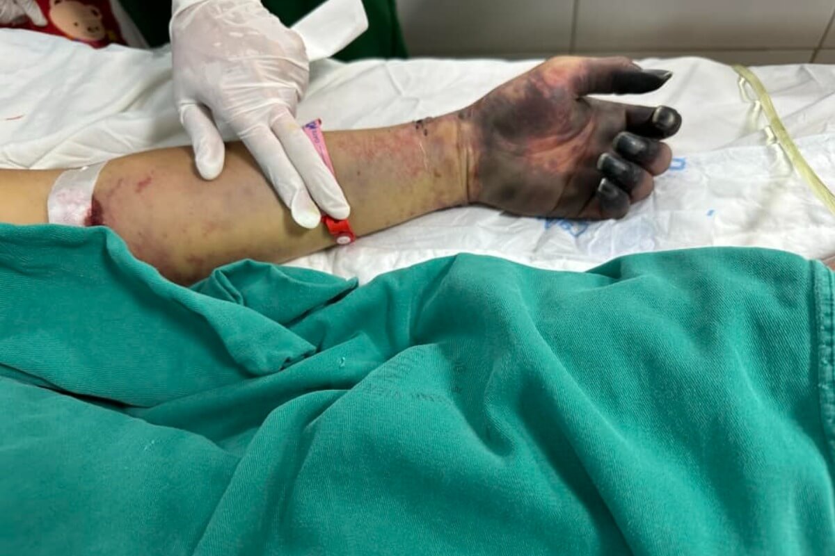 市場で買った腸詰めを食べた男性、細菌感染症で両足を切断