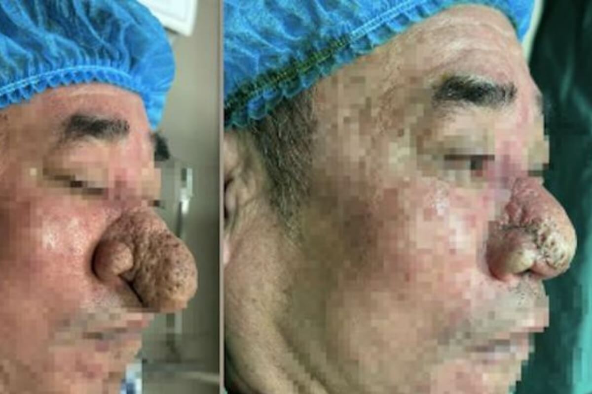 ライオンの鼻病？ ベトナムで鼻が異常に肥大化した男性