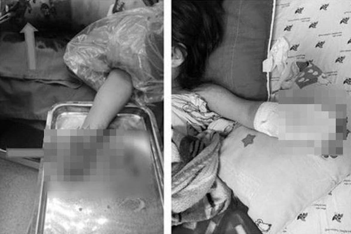 テト期間の花火事故、ホーチミンの少女が左手切断