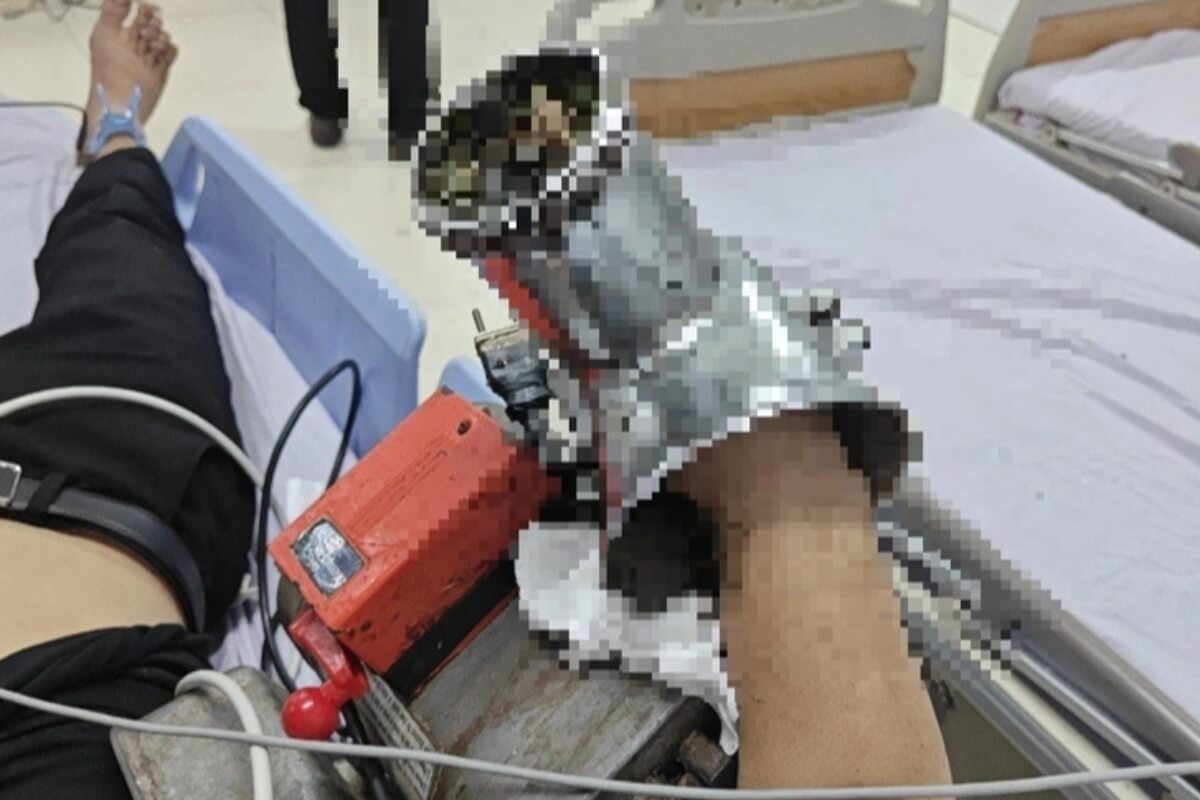 ミンチ機に腕を巻き込まれる、ホーチミンの若者が重傷