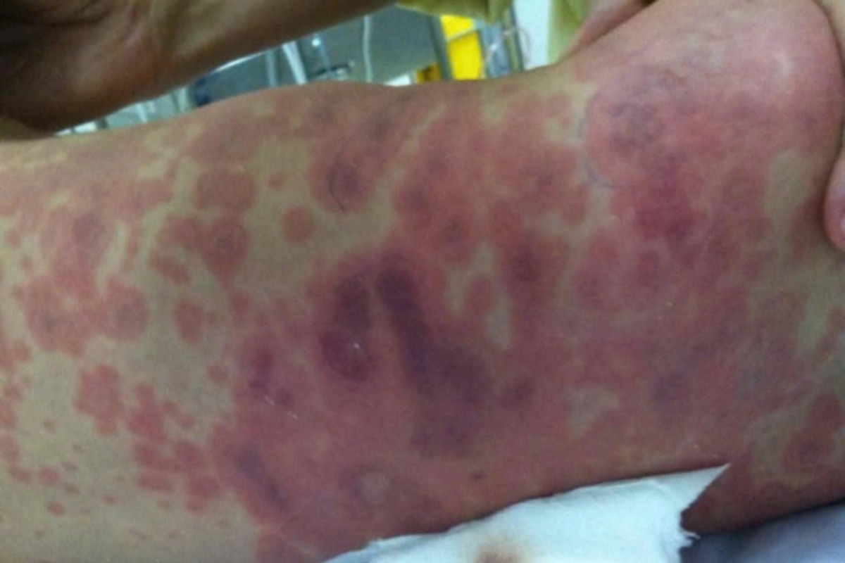 タイビンで髄膜炎菌感染症、74人が経過観察対象