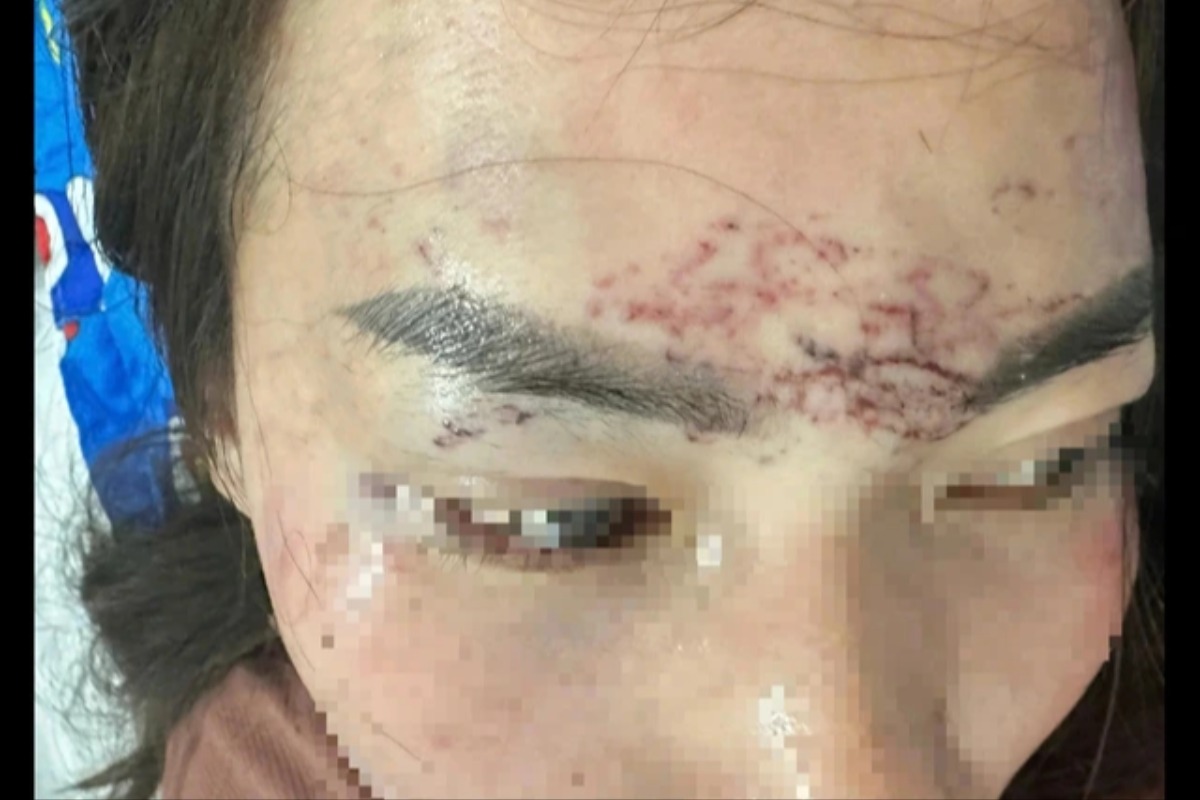 女性が顔に入れ墨・酸攻撃、嫉妬に駆られた女の犯行