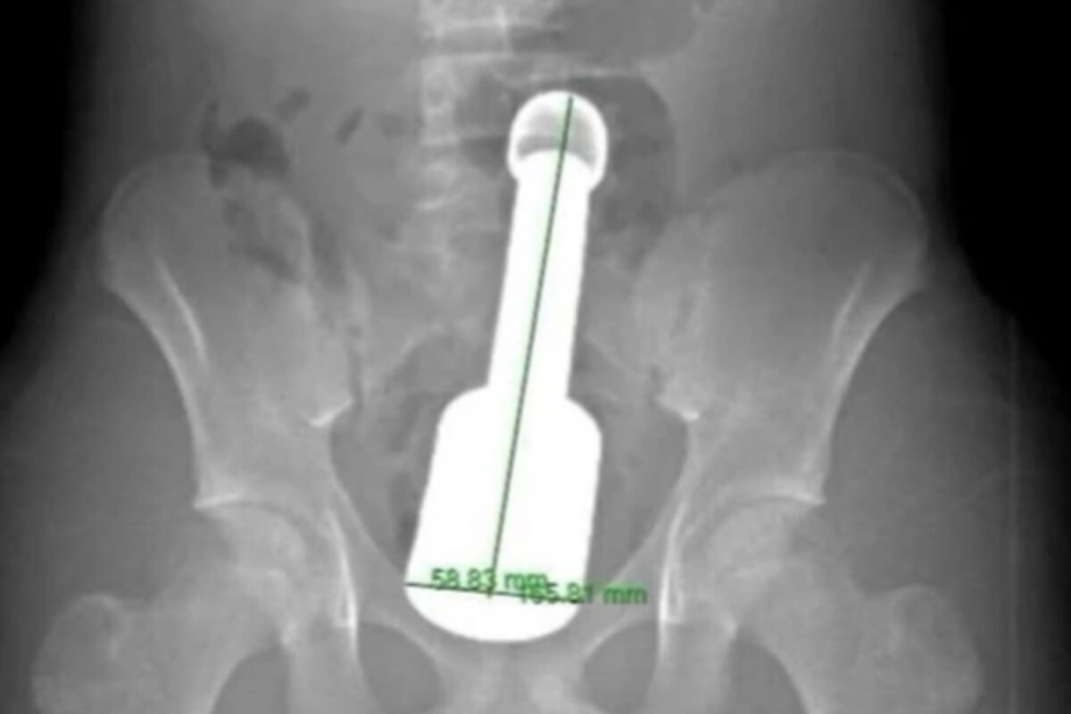 15歳少年が直腸に異物挿入、長さ18cmの金属塊を無事摘出