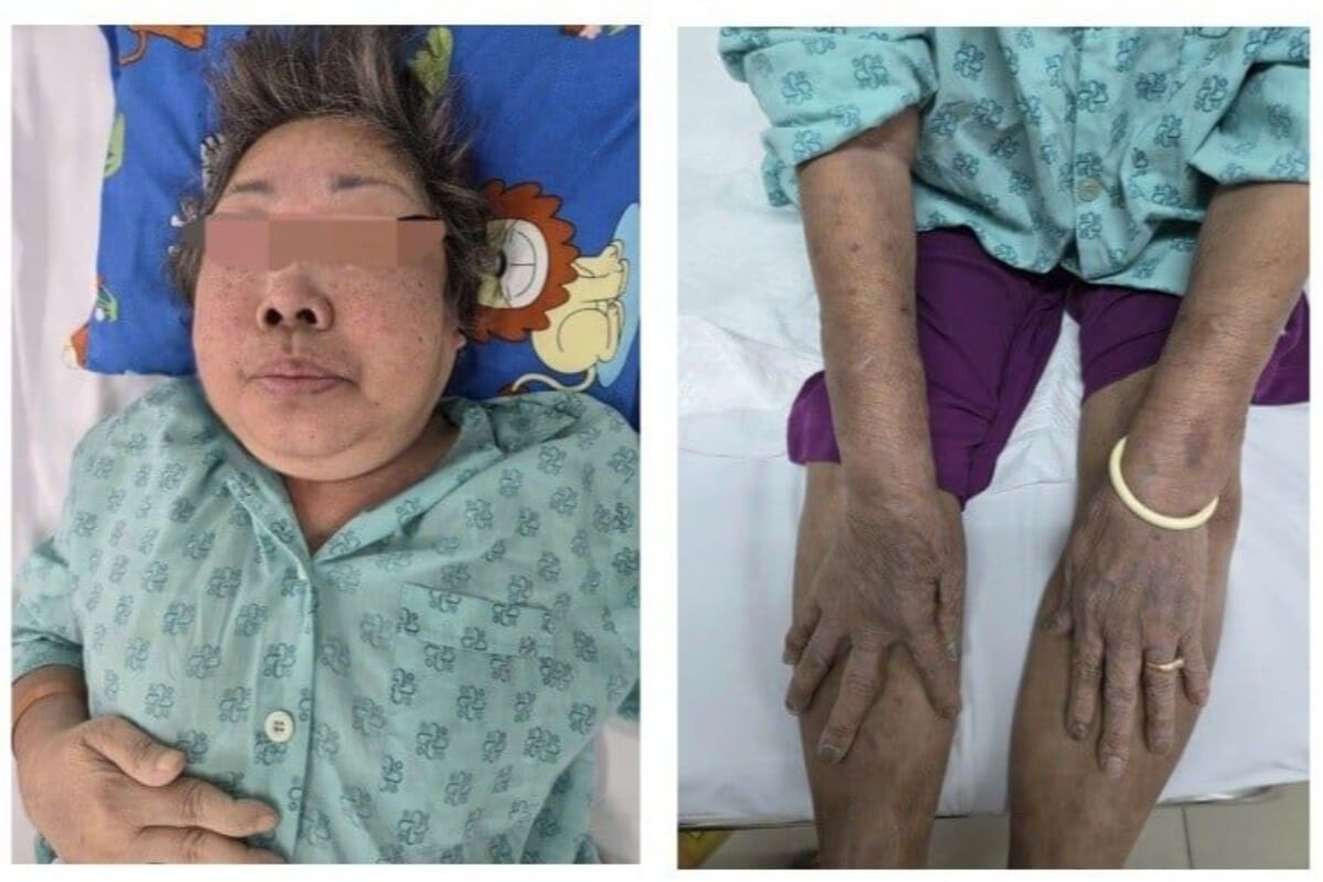 慢性副腎不全と顔貌変化、ステロイド乱用が招く代償