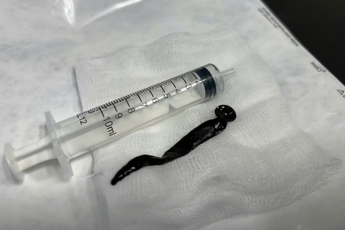 気道に12センチのヒル潜伏、少女を襲った衝撃の医療事例