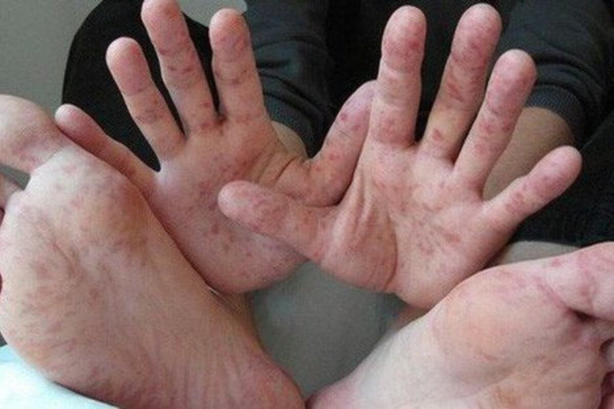 南部で手足口病が異例の拡大、3歳未満の重症例が急増