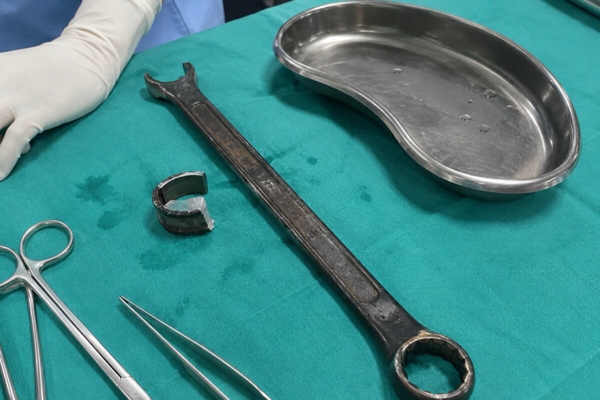 男性器がスパナに挟まり救急搬送、高速ドリルで摘出し後遺症なし