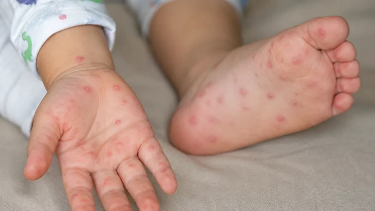 手足口病が急拡大、患者10万人超で保健省が全国に予防徹底を呼びかけ